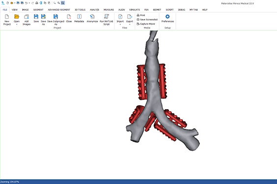 A patient's tracheal anatomy in Materialise Mimics software with tracheal splints