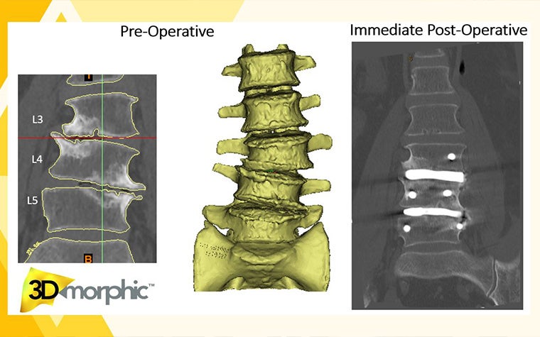 A series of scans showing the difference between a pre-operative and post-operative spine using 3DMorphic's solutions.