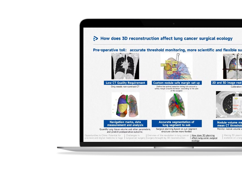 Webinar: Role of 3D Planning in Lung Cancer Surgery | Materialise