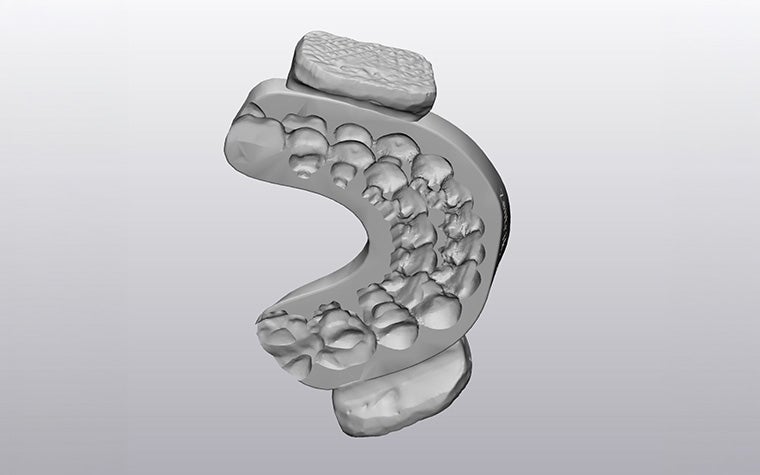 materialise-mimics-enlight-cmf-orthodontics-oral-maxillofacial-surgery-models-teeth-final-doppelimpressionen-splint.jpg
