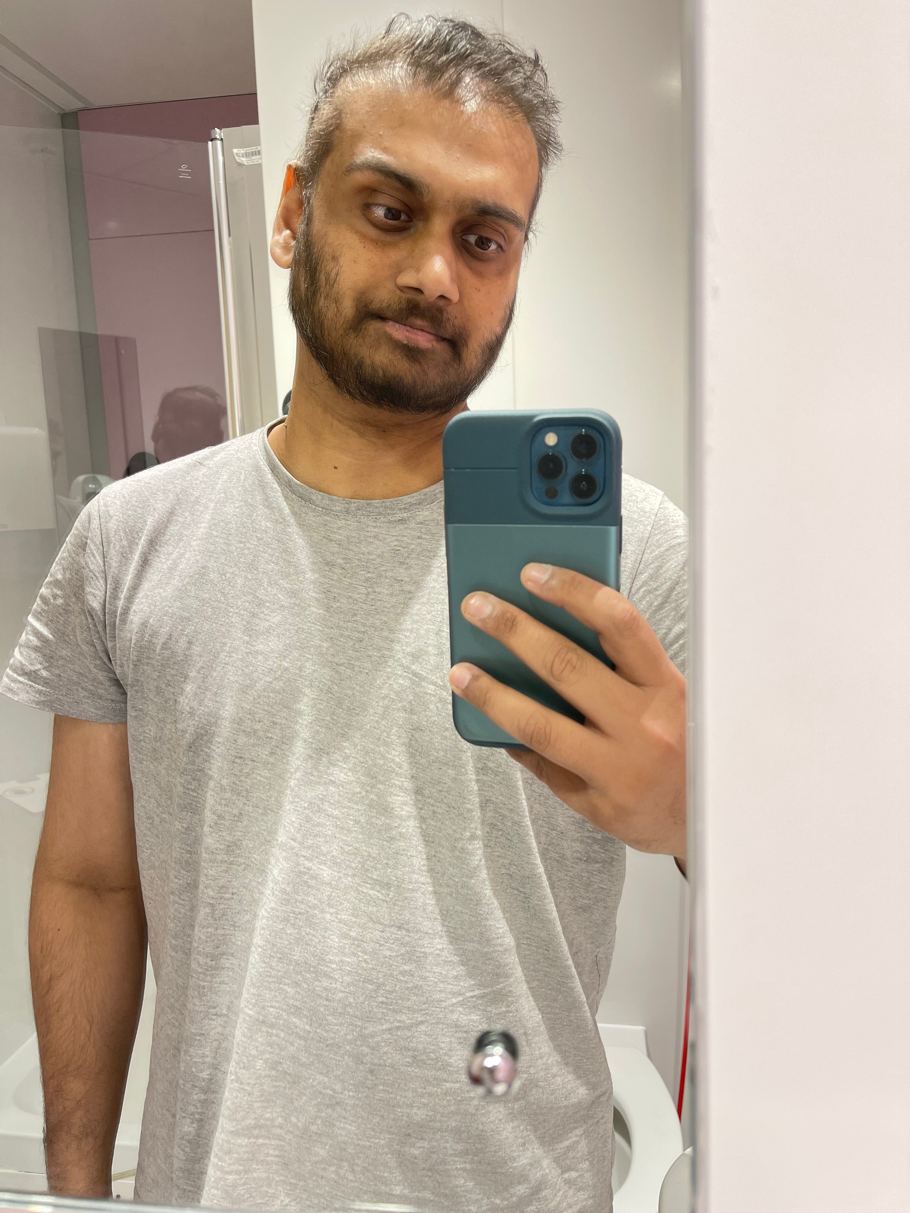 Fahad shows the effects of his treatment.