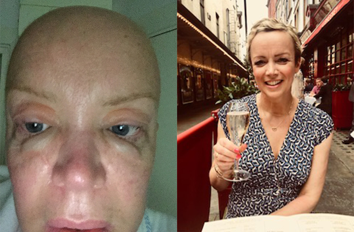 Lisa Jackson before and after AML