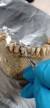 Über Zahnsteinablagerungen mittelalterlicher Mumien werden derzeit Informationen zu Ernährung, Mundgesundheit und Verwendung von Heilpflanzen rekonstruiert. (Foto: LPA/Eurac Research) 