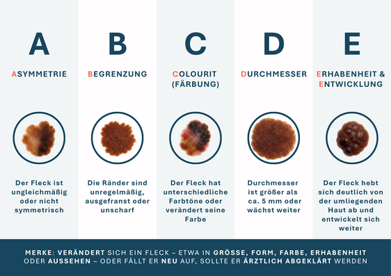  Die ABCDE-Regel hilft bei der Einschätzung von Muttermalen. (Grafik: LPA/Viktoria Huber)