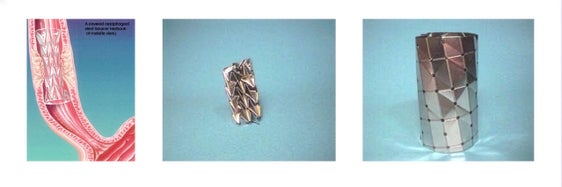 Uno degli esempi pratici illustrati durante il seminario di matematica: stent ripiegato e disteso durante l'inserimento in caso di stenosi coronarica.