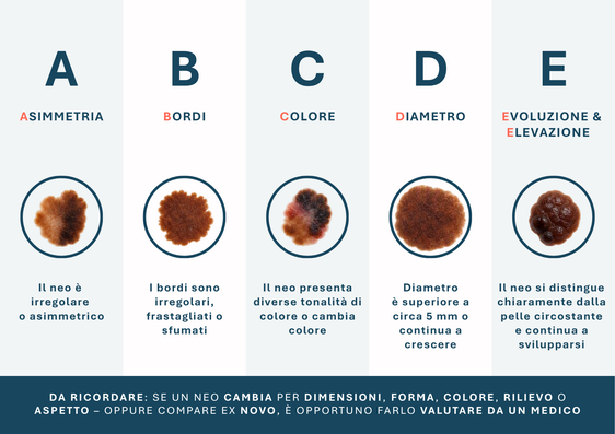 La regola ABCDE aiuta nella valutazione dei nei. (Infografica: USP/Viktoria Huber)
