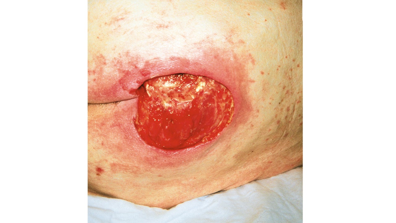 Malnutrition_Dekubitus