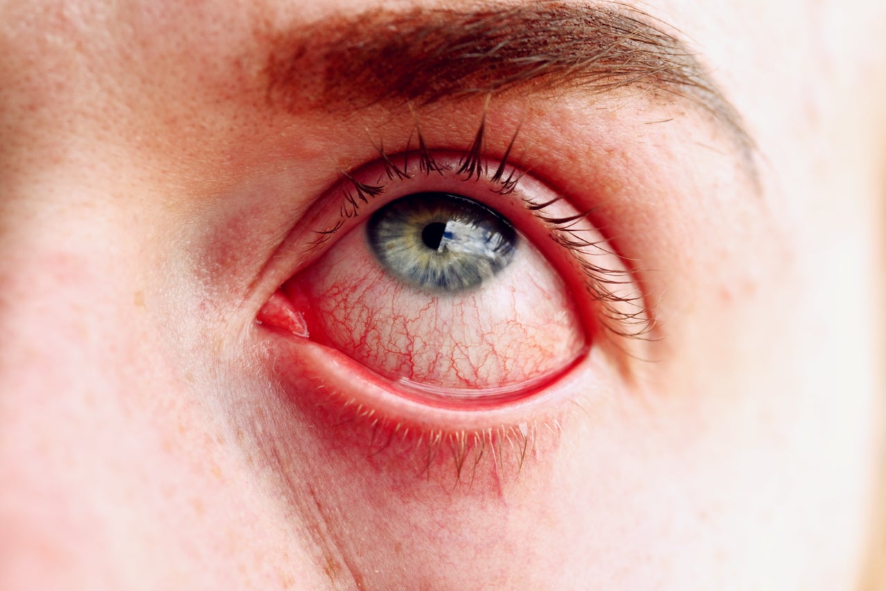 Quand un corps étranger pénètre dans l’oeil