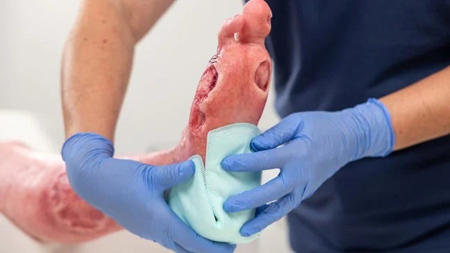 Anwendung der Wundauflage Zetuvit Plus