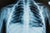 Video: tracking cystic fibrosis