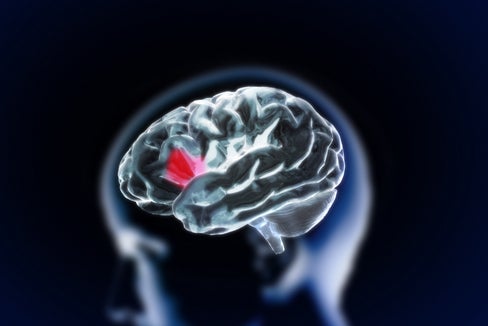 Schlaganfall - jede Minute zählt (Foto 123rf)