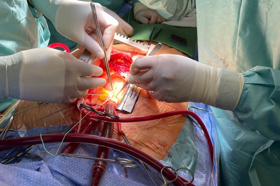 Detail Herzoperation