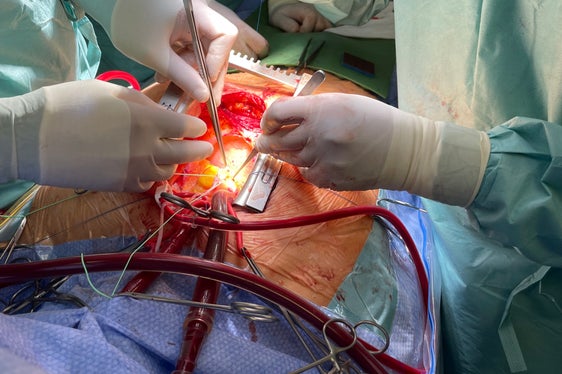 Detail Herzoperation