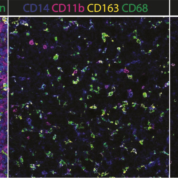 Myeloïde immuuncellen zijn veel aanwezig in hepatoblastoom
Met een speciale beeldtechniek (imaging mass cytometry) hebben we immuuncellen zichtbaar gemaakt in hepatoblastoom weefsel. Links ziet u een overzicht van de structuur van de tumor, waarbij de immuuncellen geel gekleurd zijn (CD45). In het midden is te zien dat er veel myeloïde cellen aanwezig zijn in de tumor. Rechts ziet u dat T-cellen (CD3 - groen) daarentegen bijna helemaal ontbreken.
