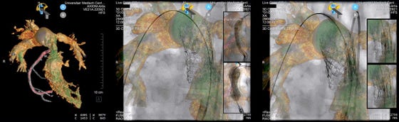 3D beelden van het hart tijden een pulmonaalklep implantatie