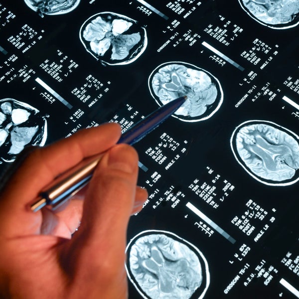 Een hand houdt een pen vast en wijst op een scan van hersenen een gedeelte aan.