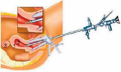 De hysteroscoop wordt via de schede in de baarmoederholte gebracht. Baarmoederwand (1), baarmoederholte (2) en eierstok (3).