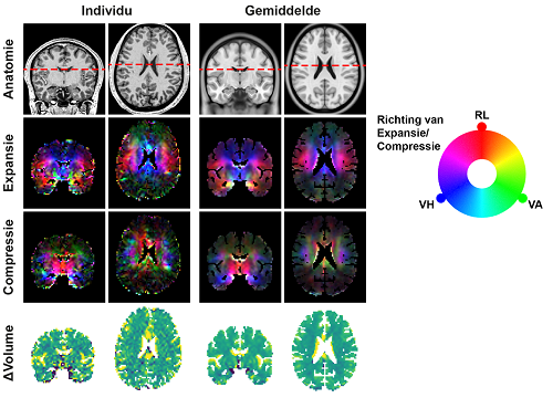 Door MRI gemaakte beelden van hersenen