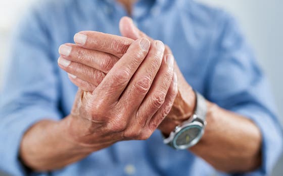 Male hand with rheumatoid arthritis complaints