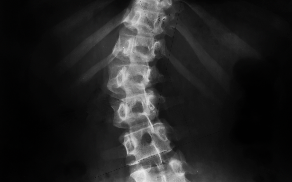 Röntgenfoto scoliose