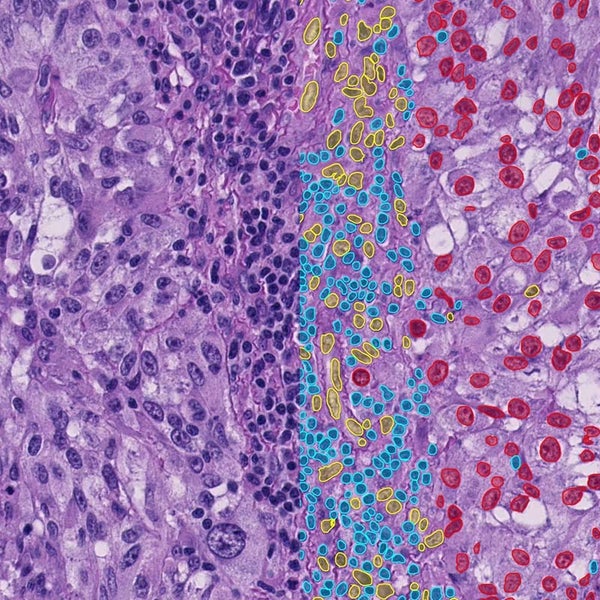 Biopsie van een melanoom met resultaten van het AI-model. In rood zijn tumorcellen, in blauw TIL's en in geel niet-tumorcellen en niet-TIL's weergegeven.