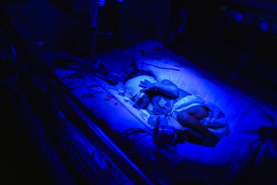 Een baby met geelzucht die speciaal blauw licht op zich krijgt (fototherapie)