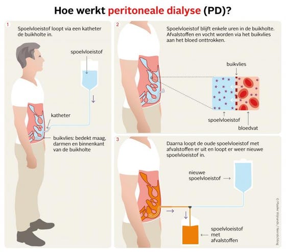 Hoe werkt peritoneale dialyse?