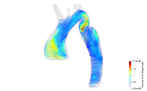 Je ziet de aorta van een patiënt. De lijnen en kleuren geven de stroomrichting en de stroomsnelheid van het bloed tijdens één hartslag.