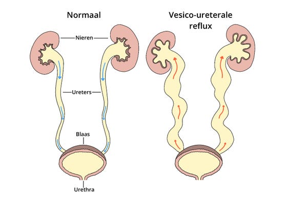 Terugstroom van urine bij VUR