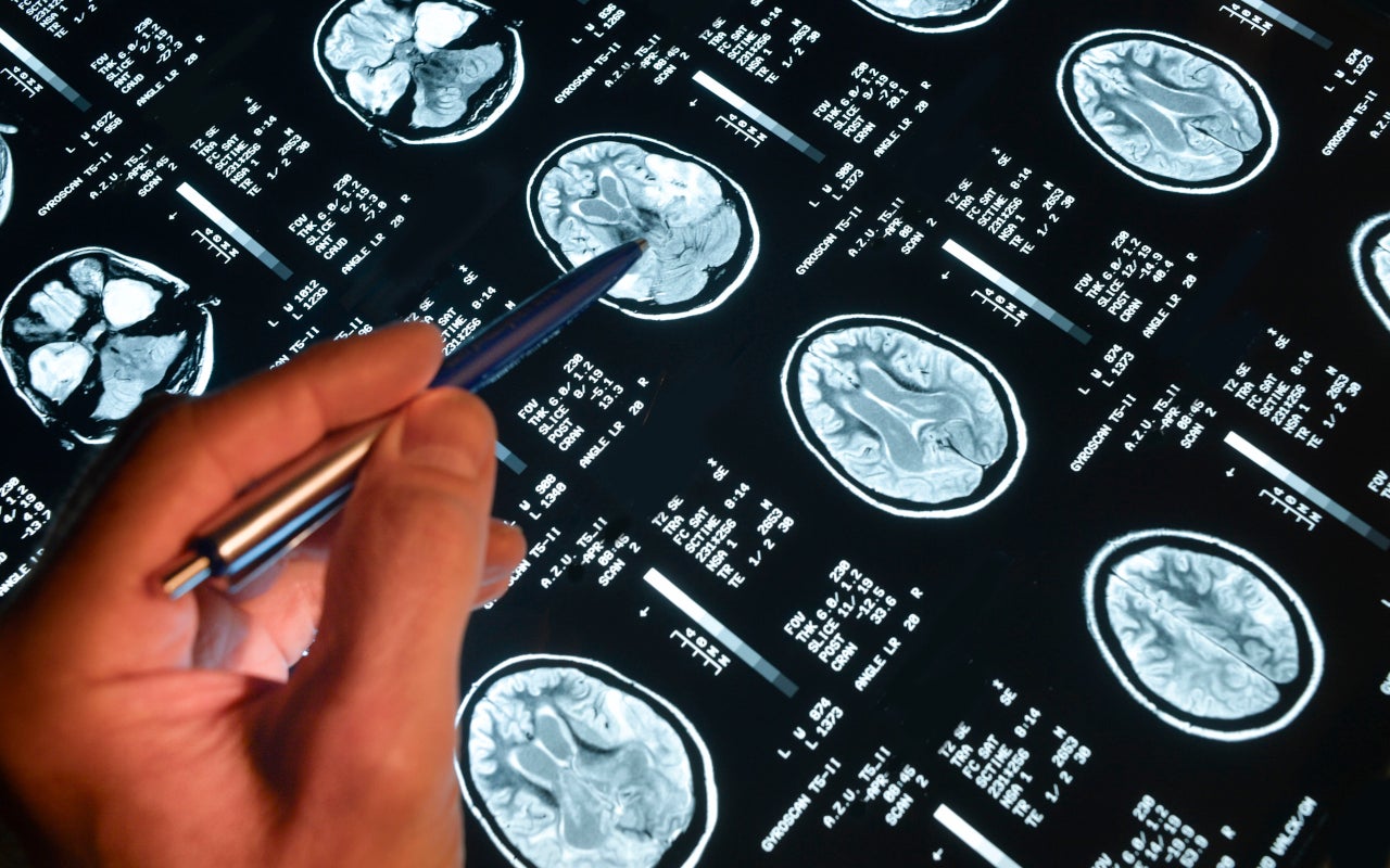 Een hand houdt een pen vast en wijst op een scan van hersenen een gedeelte aan.