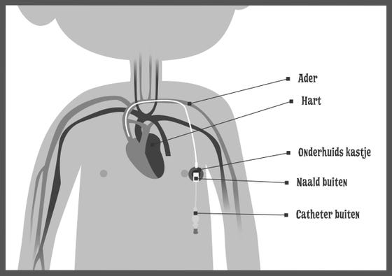 Schematische weergave van het hart en aders met labels: aders, hart, onderhuids kastje met een kabeltje die door de ader naar het hart gaat, naald buiten en catheter buiten.