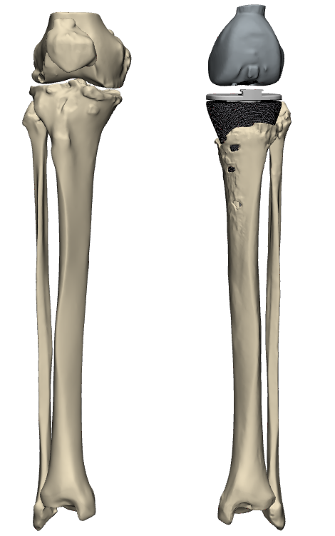 Knieprothese uit het 3D Lab