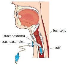 tracheacanule met cuff