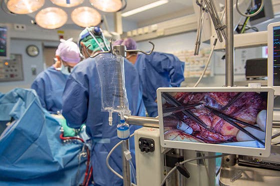Chirurgen voeren een complexe hartoperatie uit, met een scherm op de voorgrond dat een close-up van de ingreep toont in een goed uitgeruste operatiekamer