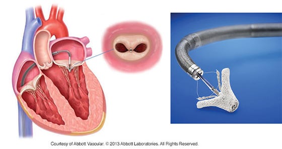 Plaatsing MitraClip