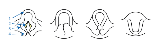 Laryngomalacie: strottenklepje (epiglottis), stembanden (glottis), aryepiglottische plooi en arythenoid. De afbeelding laat verschillende vormen van laryngomalacie zien.