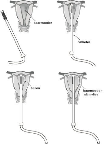 In vier illustraties uitleg over procedure balon ablatie