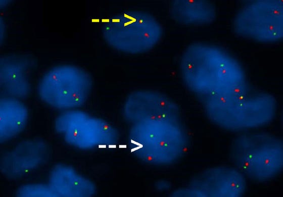 Voorbeeld van een FISH break apart probe voor BCL-2 translocatie analyse. Het groene en rode signaal liggen vlak voor en na het BCL-2gen. In normaal weefsel zullen beide signalen daardoor direct naast elkaar liggen, wat resulteert in een geel signaal (gele pijl) Als er sprake is van een translocatie is het gen gebroken en liggen het groene en rode signaal verder van elkaar vandaan.