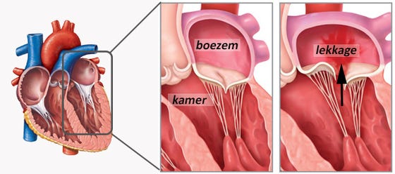 Doorsnede hart met een lekkende mitralisklep rechts in beeld