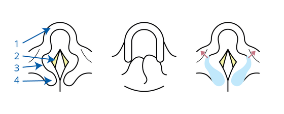 Laryngomalacie: strottenklepje (epiglottis), stembanden (glottis), aryepiglottische plooi en arythenoid. De afbeelding laat verschillende vormen van laryngomalacie zien en hoe deze aangepast kunnen worden.