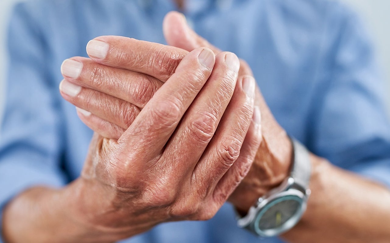 Hand of a man with rheumatoid arthritis