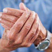 Hand of a man with rheumatoid arthritis