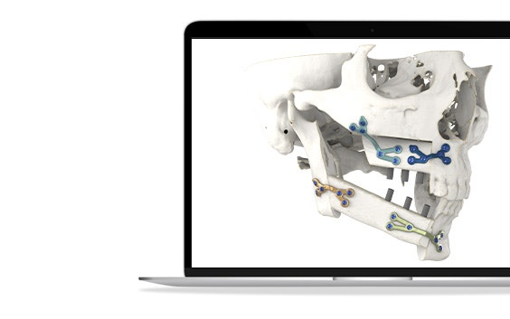 ssm-cmf-reconstruction-surgery-render-skull-3d-printed-guides.jpg