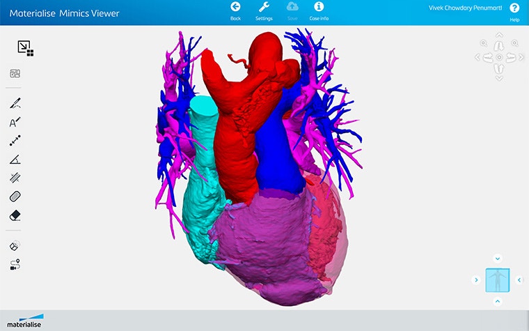 Screenshot of Materialise Mimics Viewer showing segmented heart anatomy