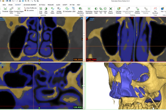 reatz3D & AuMed used Mimics to segment bone and soft tissue in the nasal cavity.