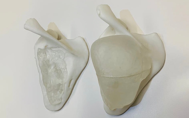 3D-printed anatomical models of a tumor showing reduced size after treatment with chemotherapy 