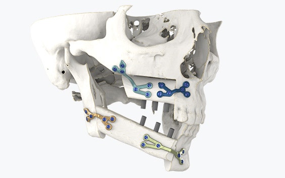 Side view of a jaw with s-plates screwd in in various locations