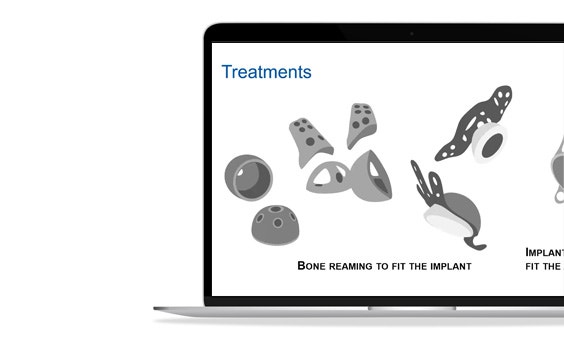ssm-treatments-standard-and-personalized-implants.jpg