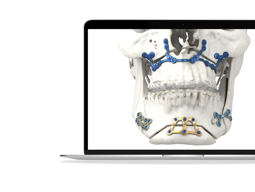 Materialise Personalized CMF solutions shown on a skull.