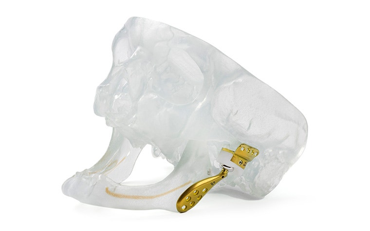 3D-printed demo skull model with a TMJ prosthesis